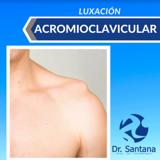 luxación acromioclavicular dr santana ortopedista cancun