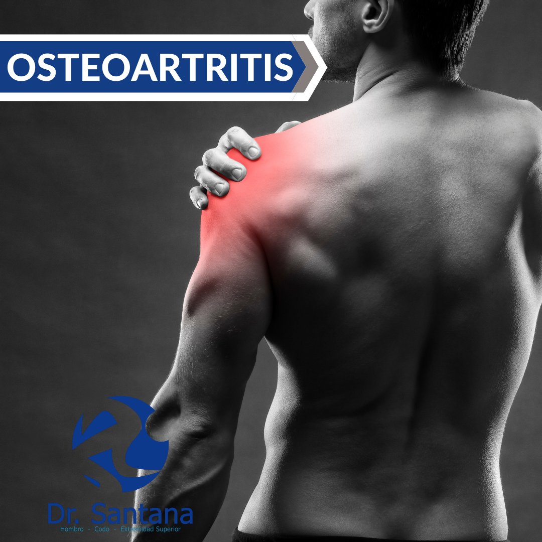 osteoartritis en cancun ortopedista santana de dios